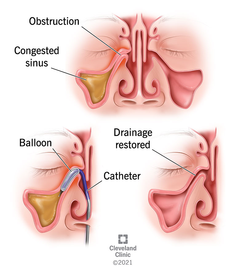 Blockage in one deals nostril