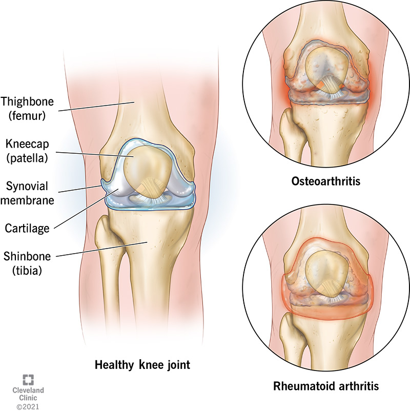 osteoarthritis symptoms knee