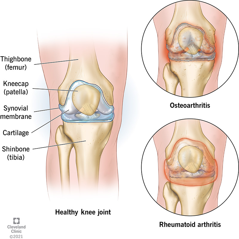Arthritis of the knee