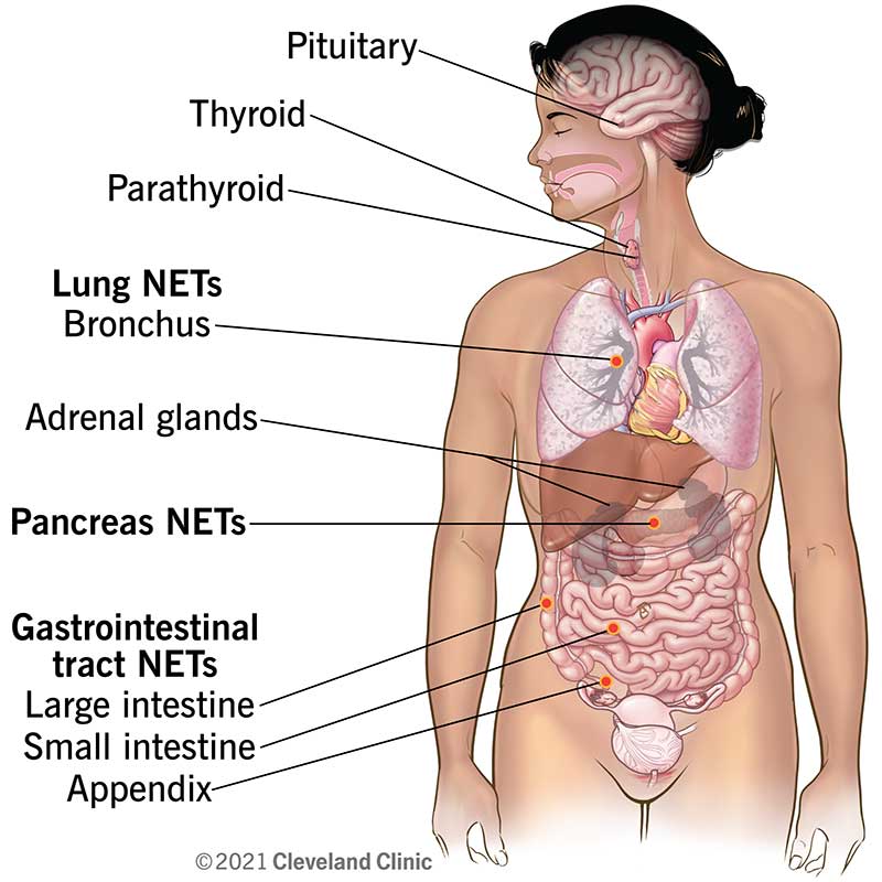 A neuroendocrine tumor (NET) begins in the specialized cells of the body's neuroendocrine system.