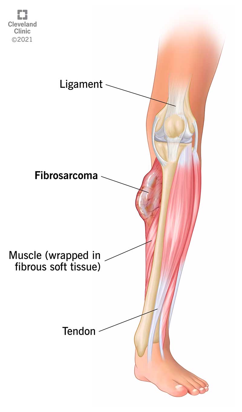 Fibrosarcoma as it may appear as a soft tissue tumor in tissues that wrap around your leg’s tendons, muscles and ligaments.
