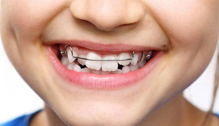 Orthodontics: Maloccclusion, other problems, and starting treatment