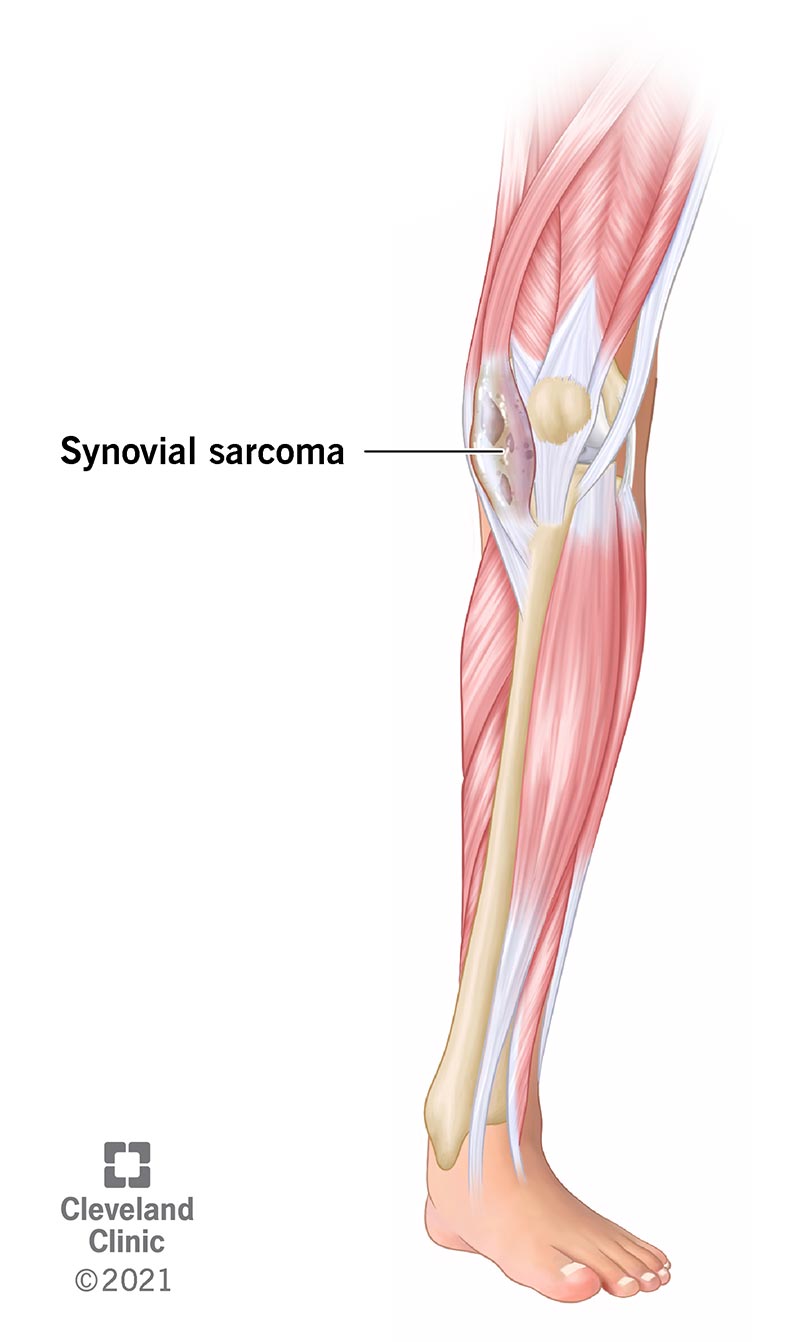 Synovial Sarcoma: What Is It, Diagnosis, Treatment & Prognosis