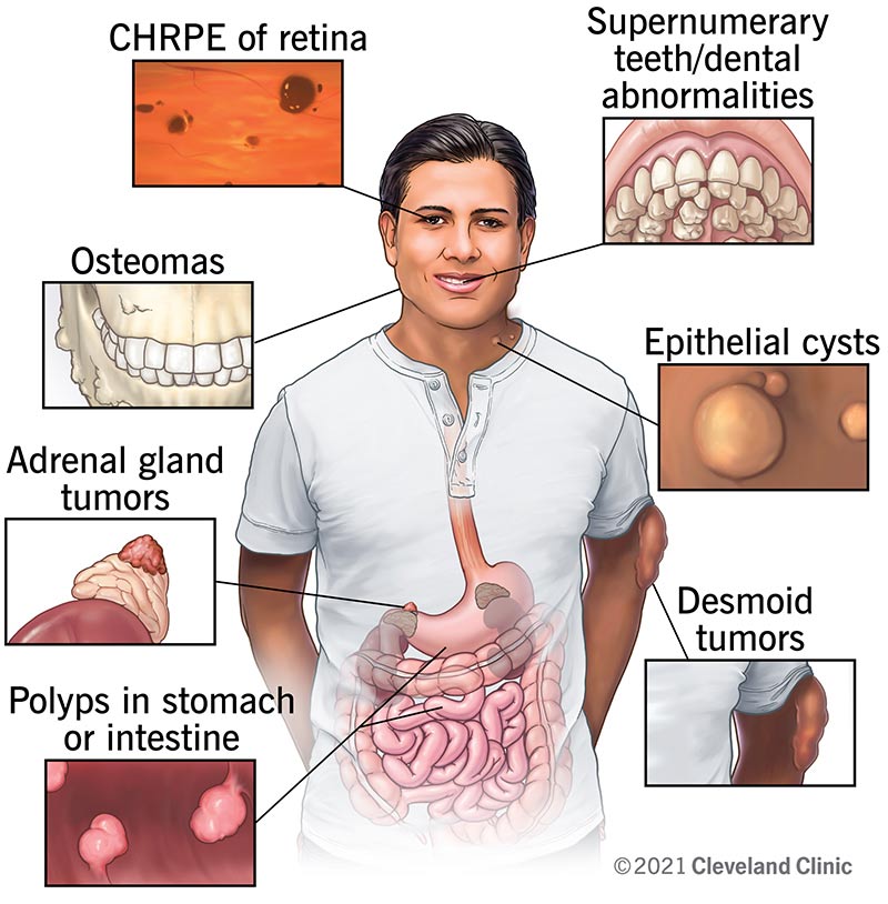 Medical illustration depicting symptoms of Gardner syndrome, a form of familial adenomatous polyposis (FAP) that is characterized by multiple colorectal polyps.