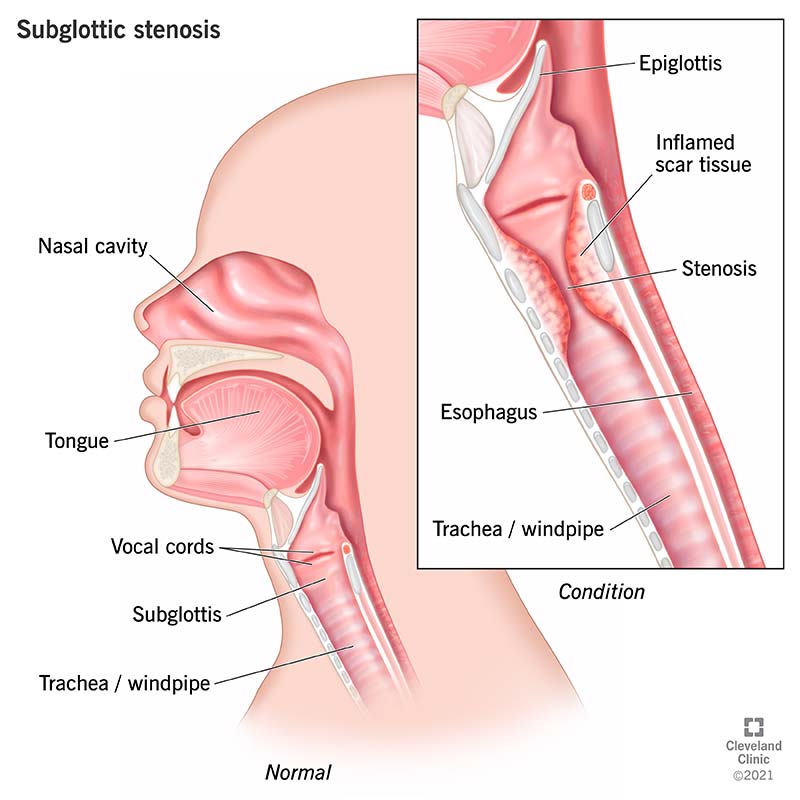Medical illustration depicting subglottic stenosis which is a narrowing of the airway just below the vocal cords.