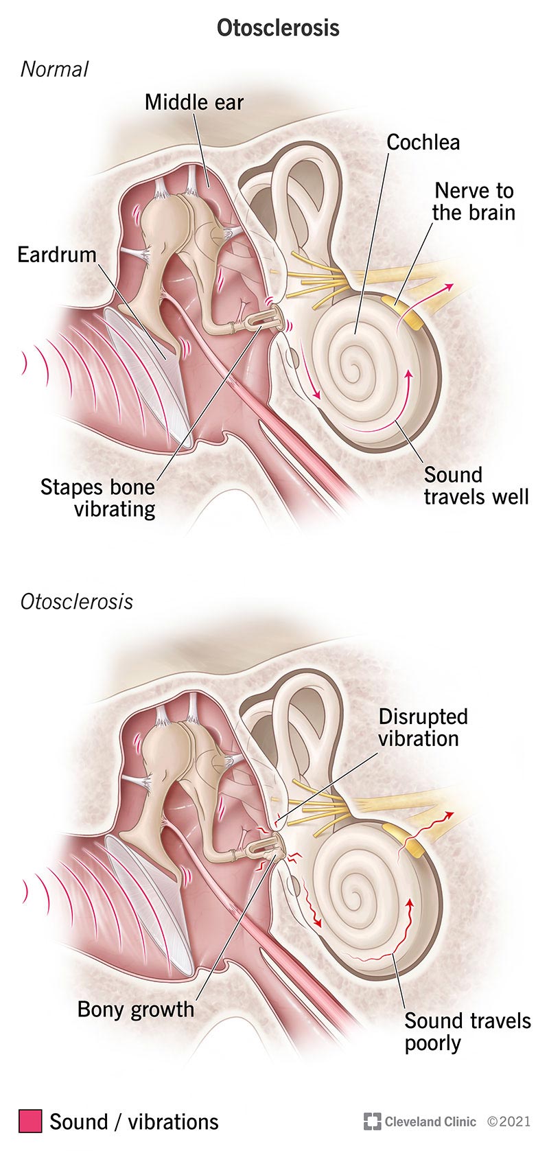 Otosclerosis Definition Surgery Symptoms