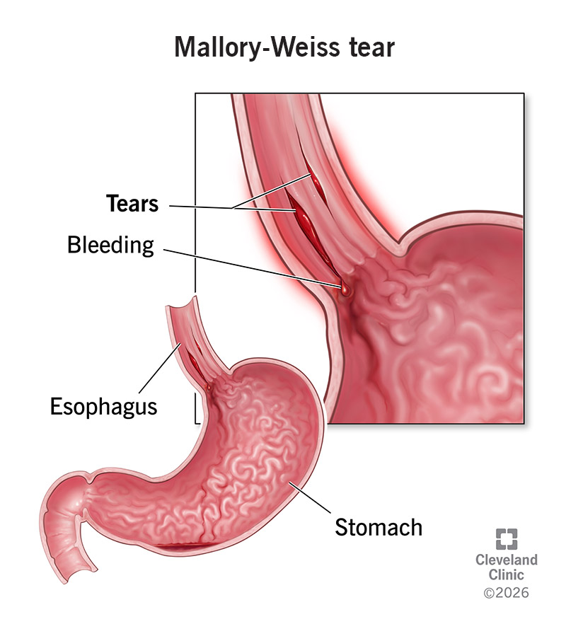 Tears in the lining of the esophagus near the stomach, causing bleeding in the upper digestive tract (Mallory-Weiss tear)