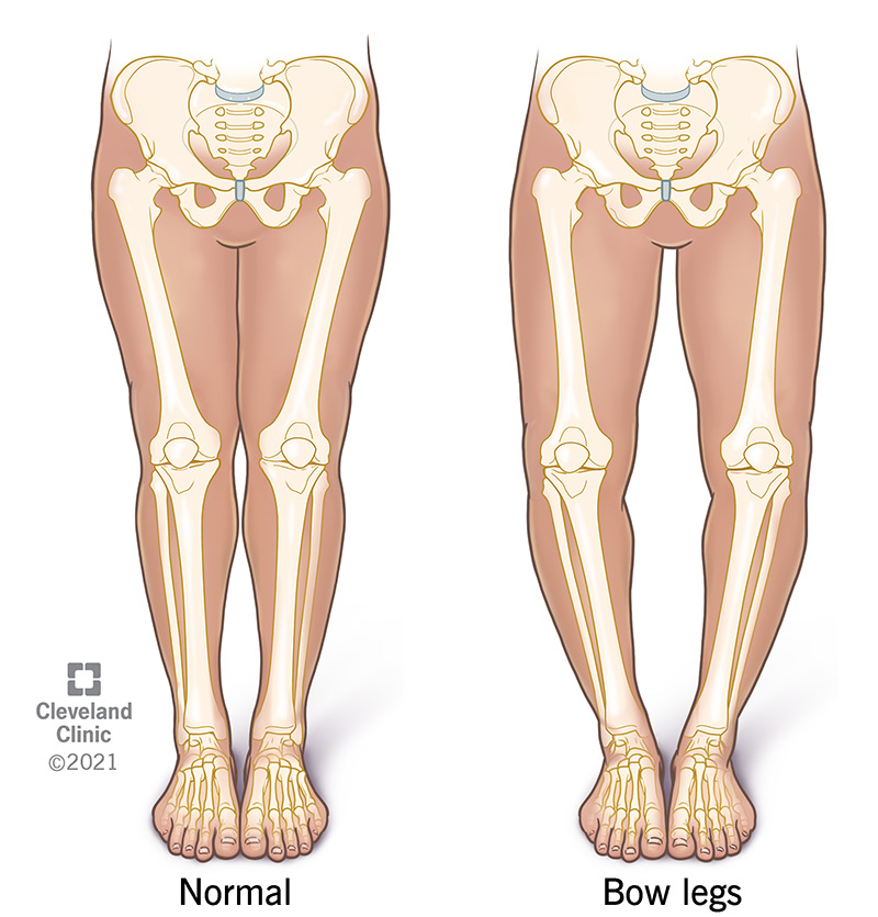 Medical illustration comparing bow legged anatomy vs normal bone anatomy. 