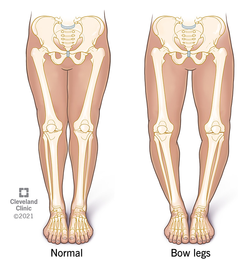 Medical illustration comparing bow legged anatomy vs normal bone anatomy.