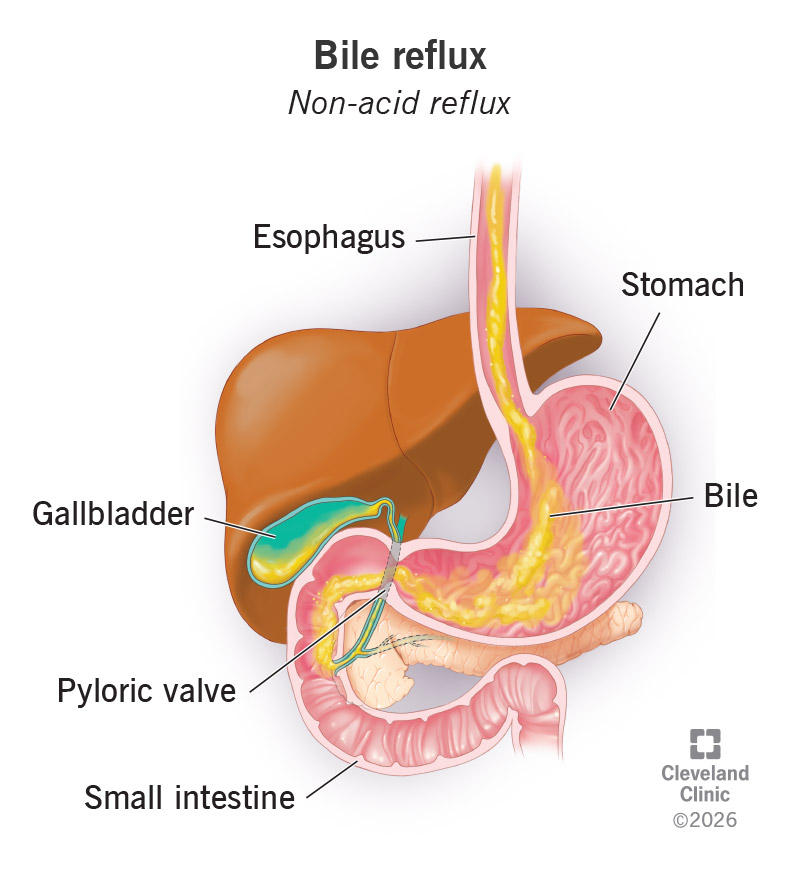Bile flowing up from small intestine and into the stomach and esophagus above it