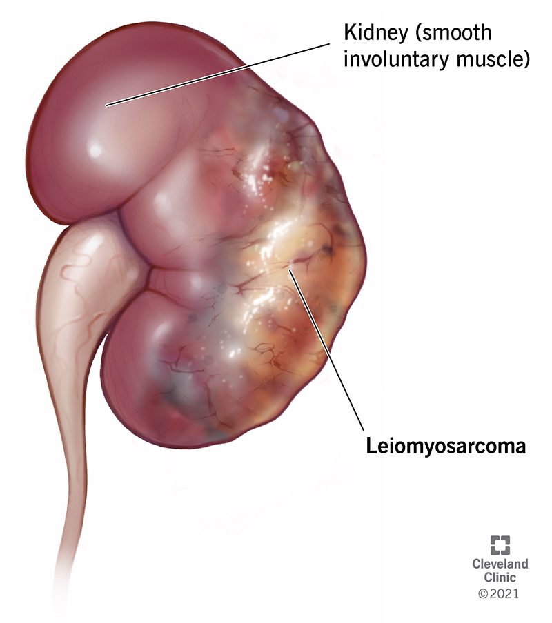Medical illustration example of a Leiomyosarcoma affecting a kidney.