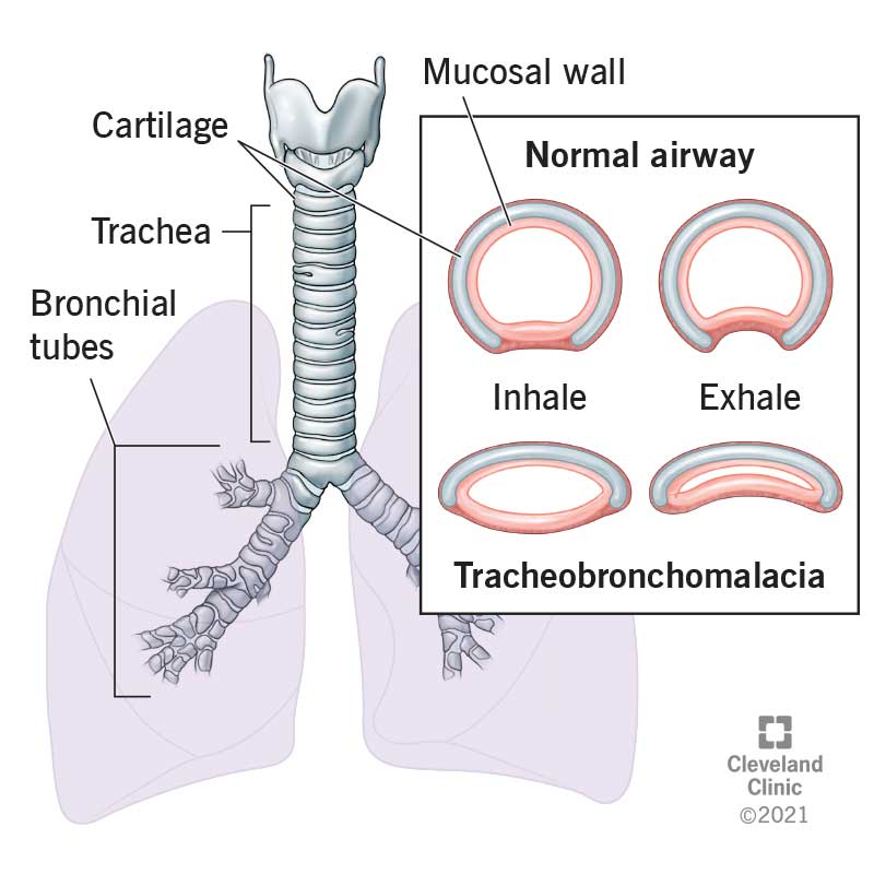 Diagram of trachea and bronchial tubes on left. On right, detail on how tracheomalacia narrows trachea and closes airways
