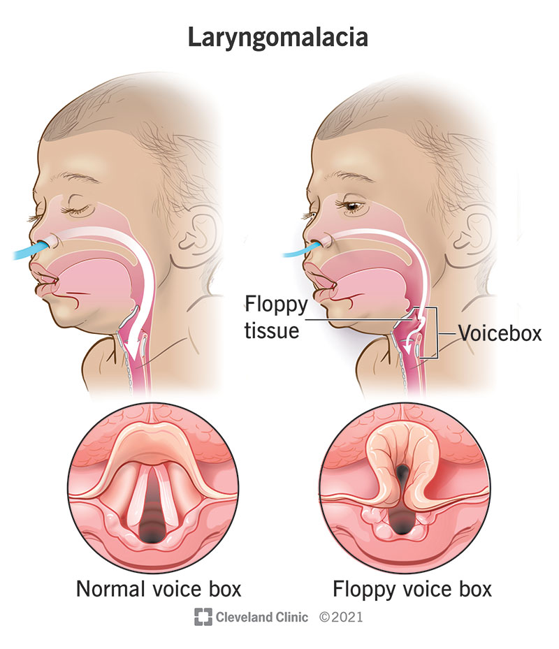 Airflow in infant with typical voice box vs. in infant with floppy voice box as in laryngomalacia