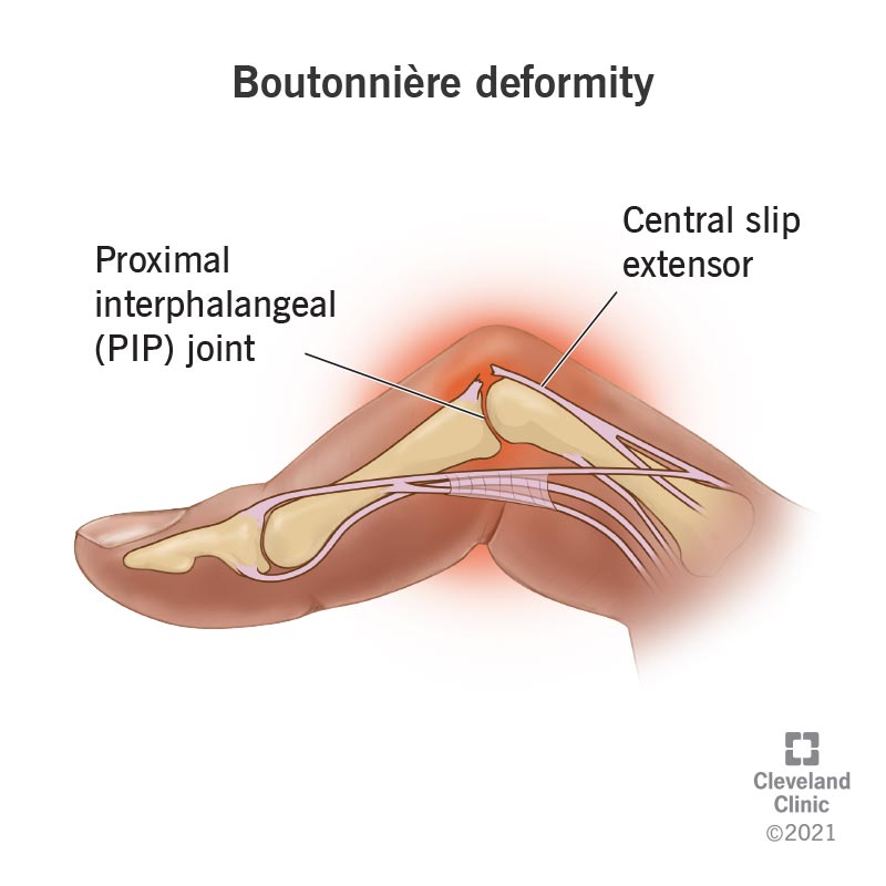 A boutonnière deformity of the finger is caused by a tear in the central slip extensor at the proximal interphalangeal joint (PIP).