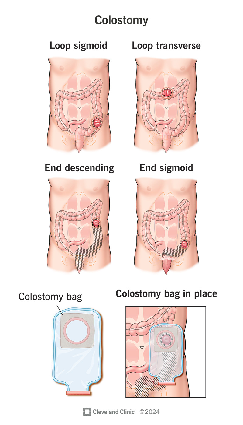 Comparison between types of colostomy; colostomy bag in place over stoma.