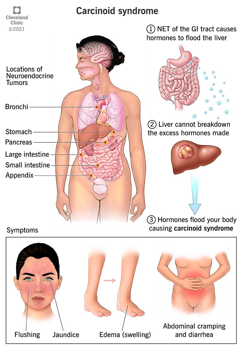 Top: Female with gastrointestinal neuroendocrine tumor showing how NET of GI causes carcinoid syndrome. Below are symptoms.