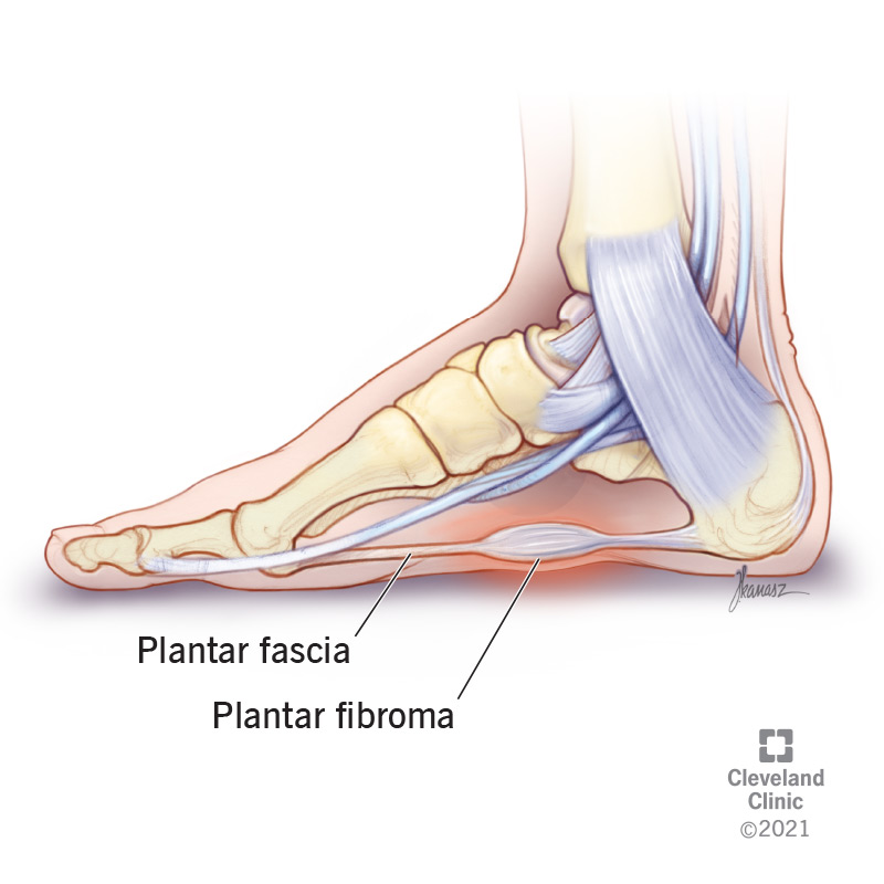 Plantar fibroma growing on the arch of a foot.
