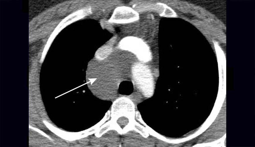 Bronchogenic cyst forming in the mediastinum, as shown on CT scan.