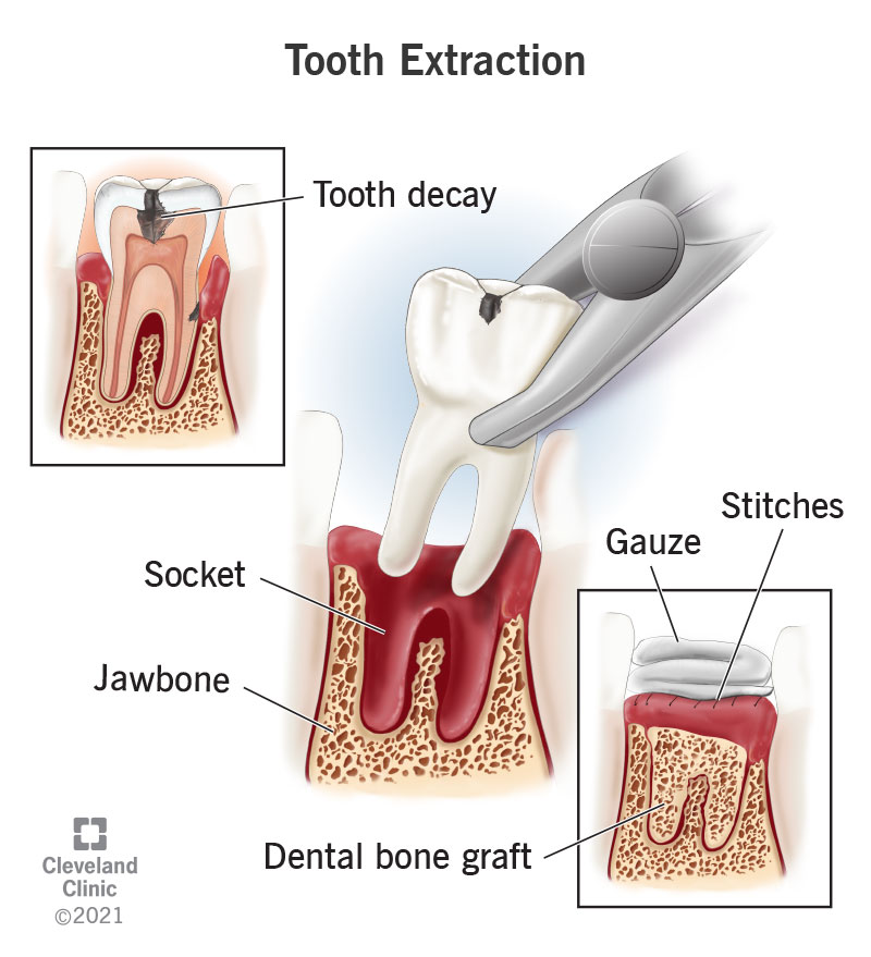 A tooth extraction may be necessary for many reasons, including severe damage or decay.