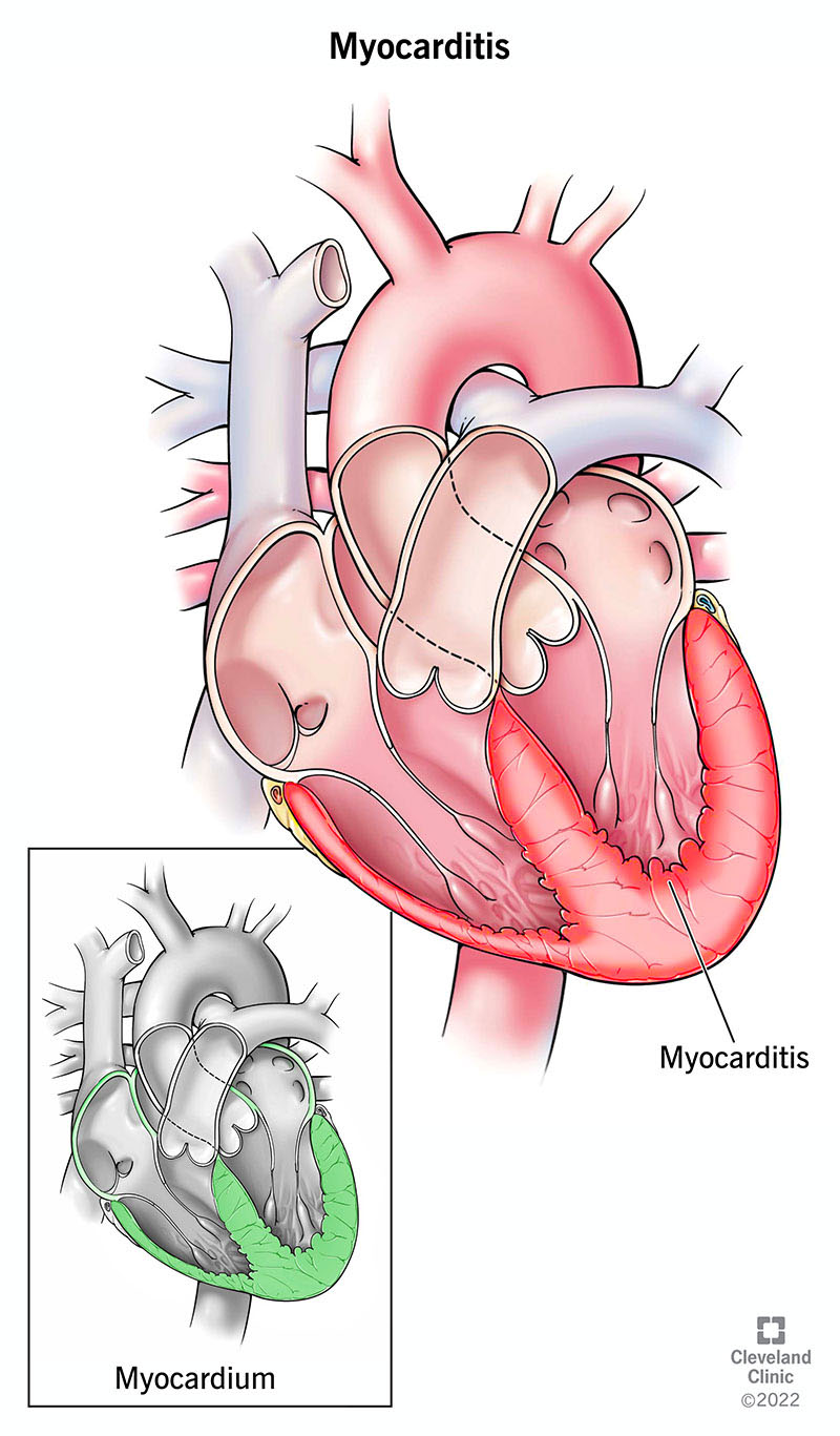 Myocarditis, or inflammation that affects your heart muscle (myocardium).