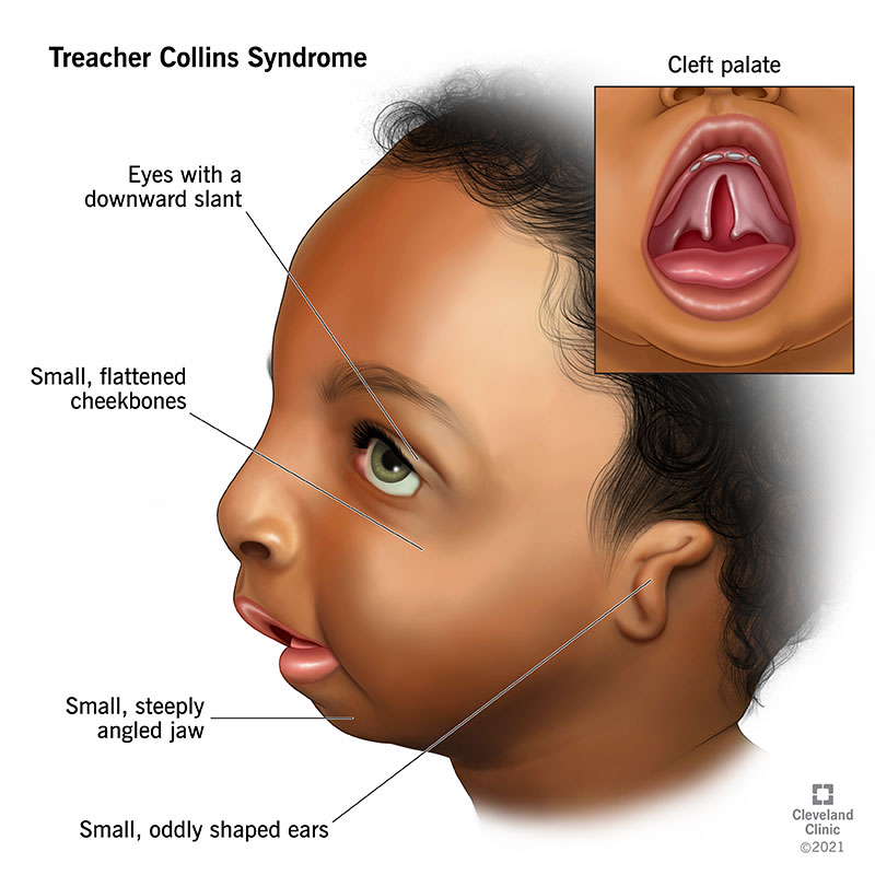 Child with Treacher Collins syndrome symptoms including details about shape of eyes, jaw, ears and cheekbones. Top right-close up of cleft palate. 