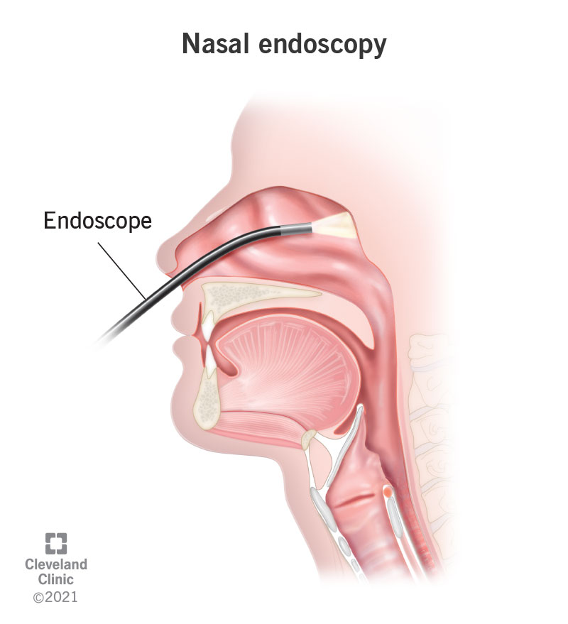 Medical illustration of an endoscope going up the nasal passage.