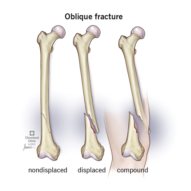 An oblique fracture angles across a bone.