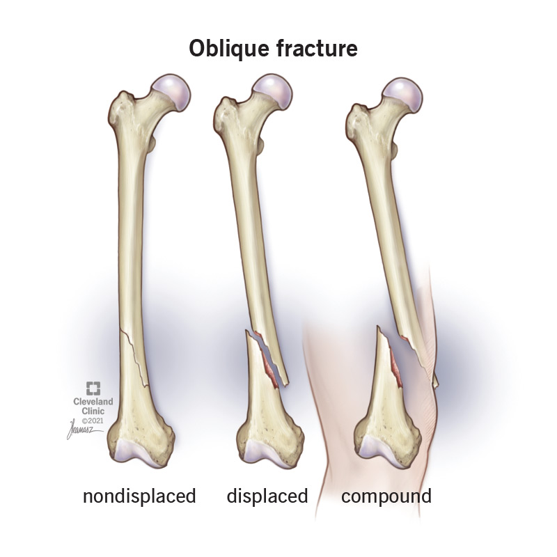 oblique fracture