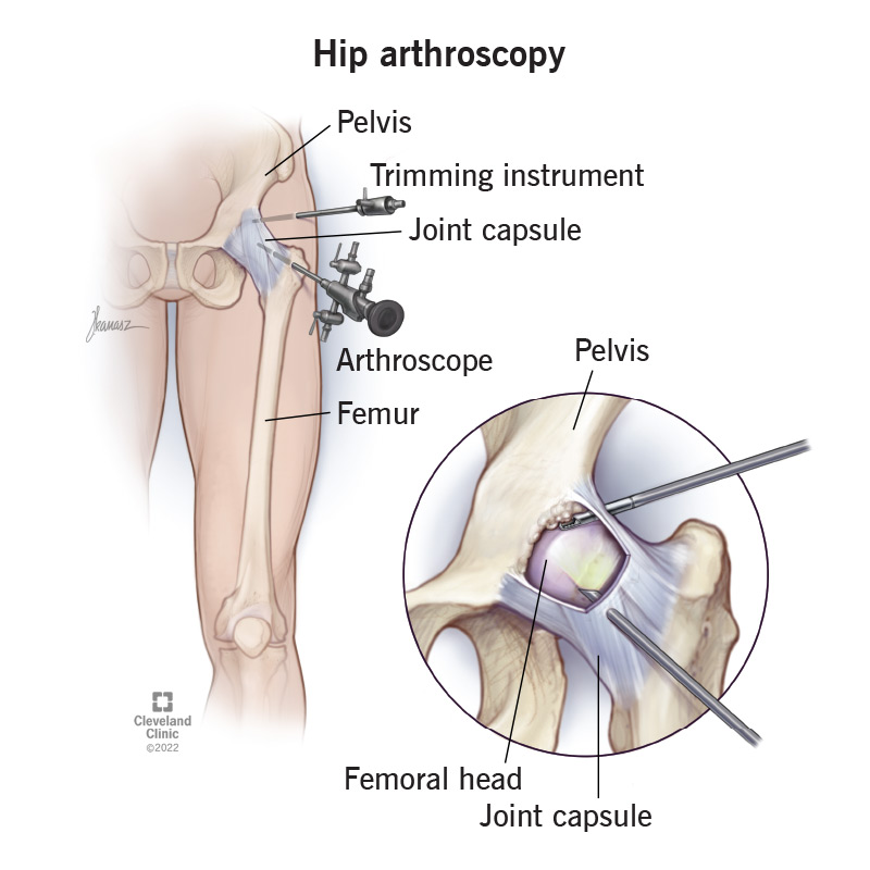 A hip arthroscopy performed on a person’s left hip.