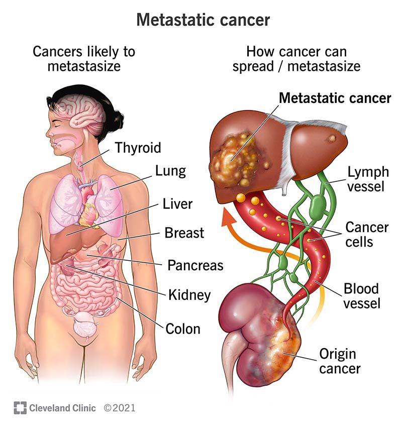 Metastatic cancer spreads through your blood or lymph system.
