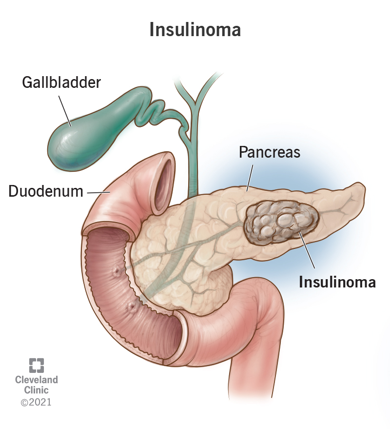Duodenum shown at left. Gallbladder shown above duodenum. Pancreas with insulinoma tumor shown at right of duodenum.