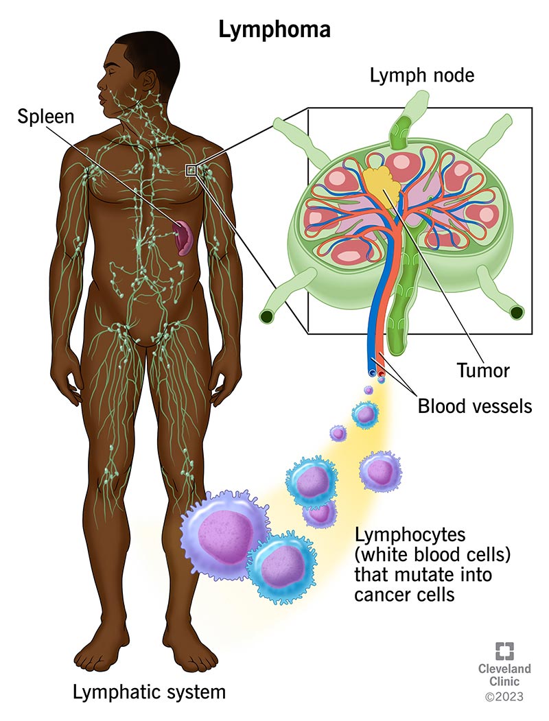 Lymphoma is cancer that starts in your white blood cells (lymphocytes). You have lymph nodes throughout your body. A swollen lymph node may be a sign of lymphoma in your lymph node.