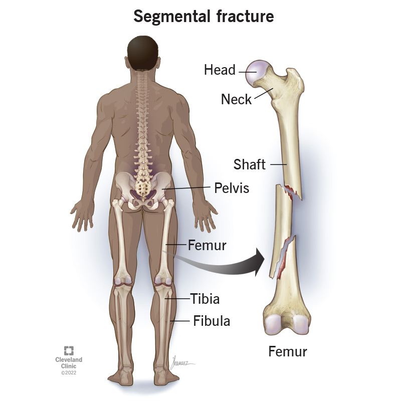 A segmental fracture in a femur.
