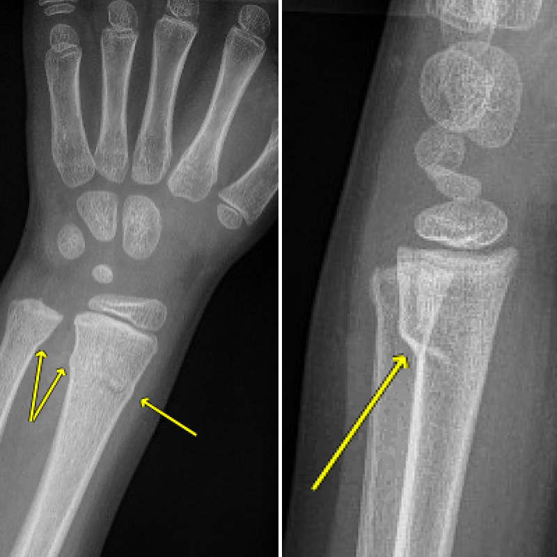 A buckle fracture bulges a wrist out of place.