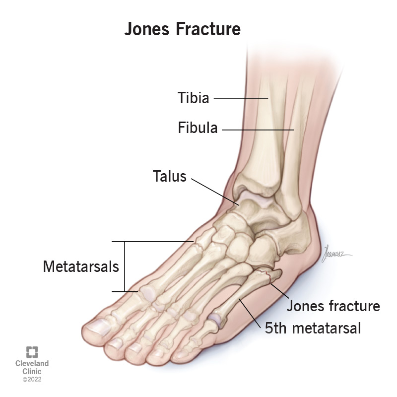 Diagram of bones in foot and ankle illustrates location of a Jones fracture in the fifth metatarsal.