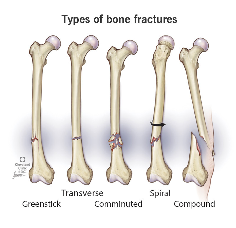 Spiral fractures twist around bones.