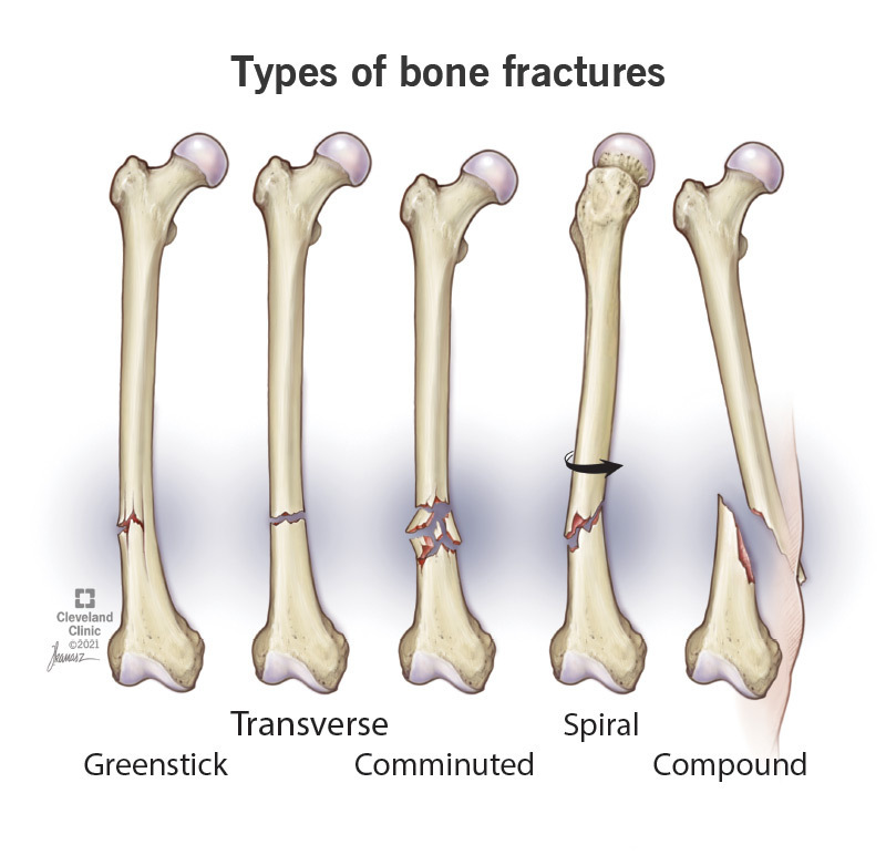 Is A Spiral Fracture Worse Than A Break