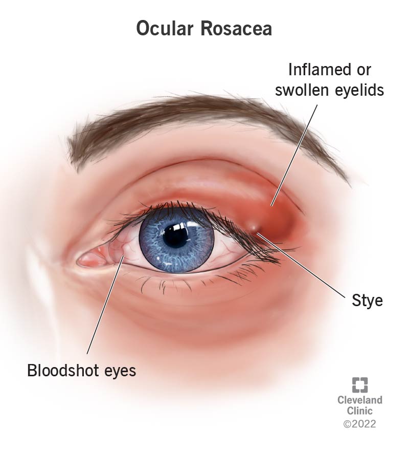 Ocular rosacea affects eyes and the skin around them.