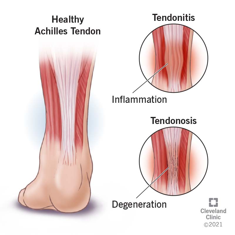 The effect of tendinopathy (tendonitis and tendinosis) on the Achilles tendon.