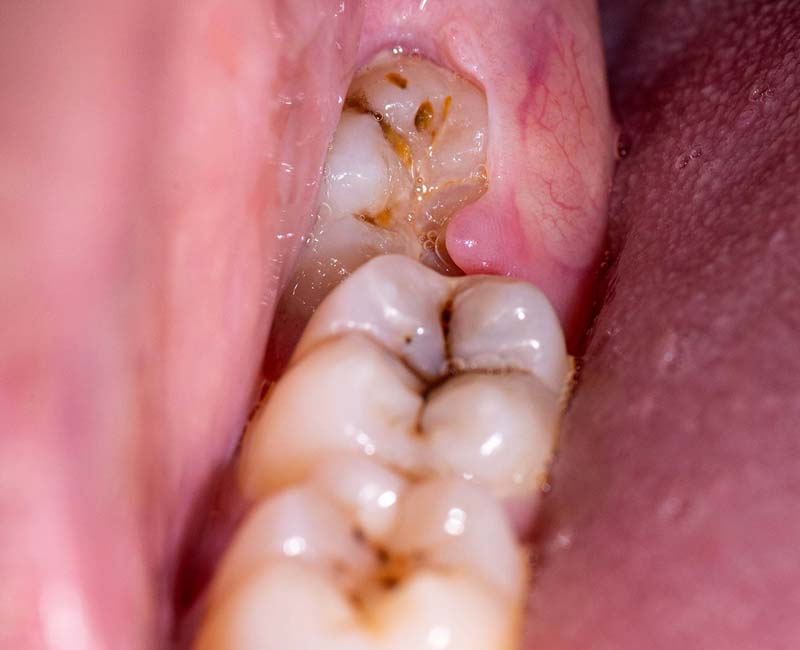 Wisdom teeth that don't erupt from the gums properly are referred to as impacted wisdom teeth.