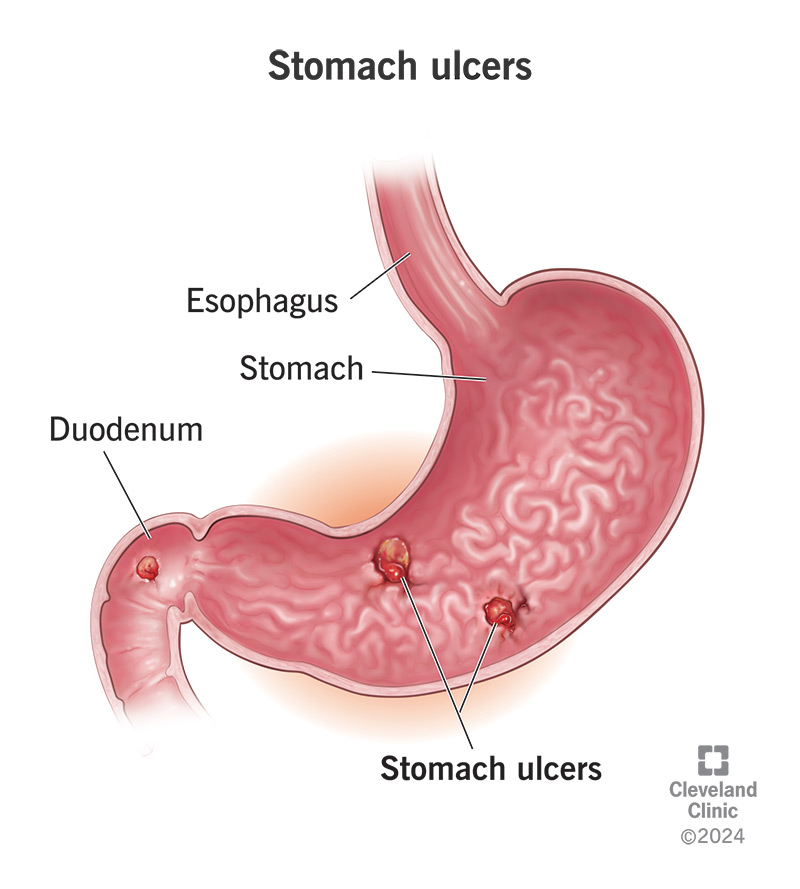 Inside view of stomach with ulcers