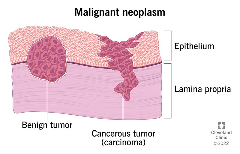 Malignant neoplasms spread and invade nearby tissues.