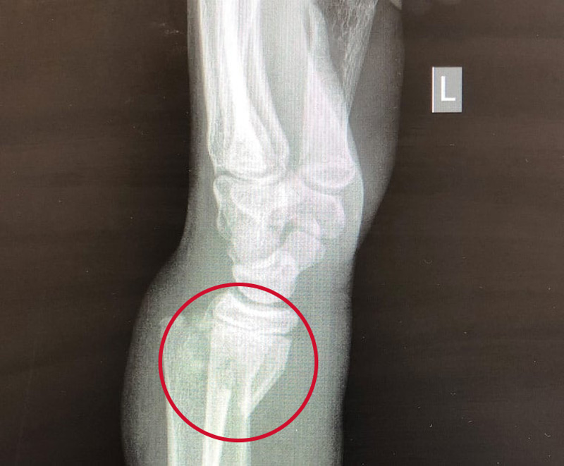 X-ray of a Smith fracture of the wrist.