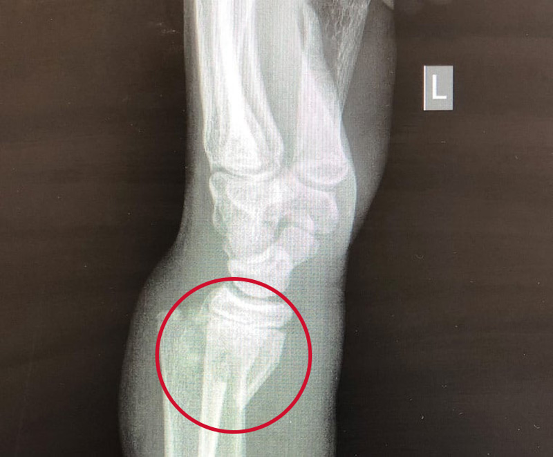 colles fracture xray