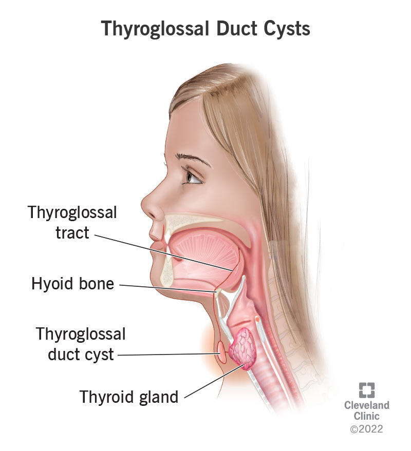 Swollen area caused by thyroglossal duct cyst located next to thyroid gland and below hyoid bone.