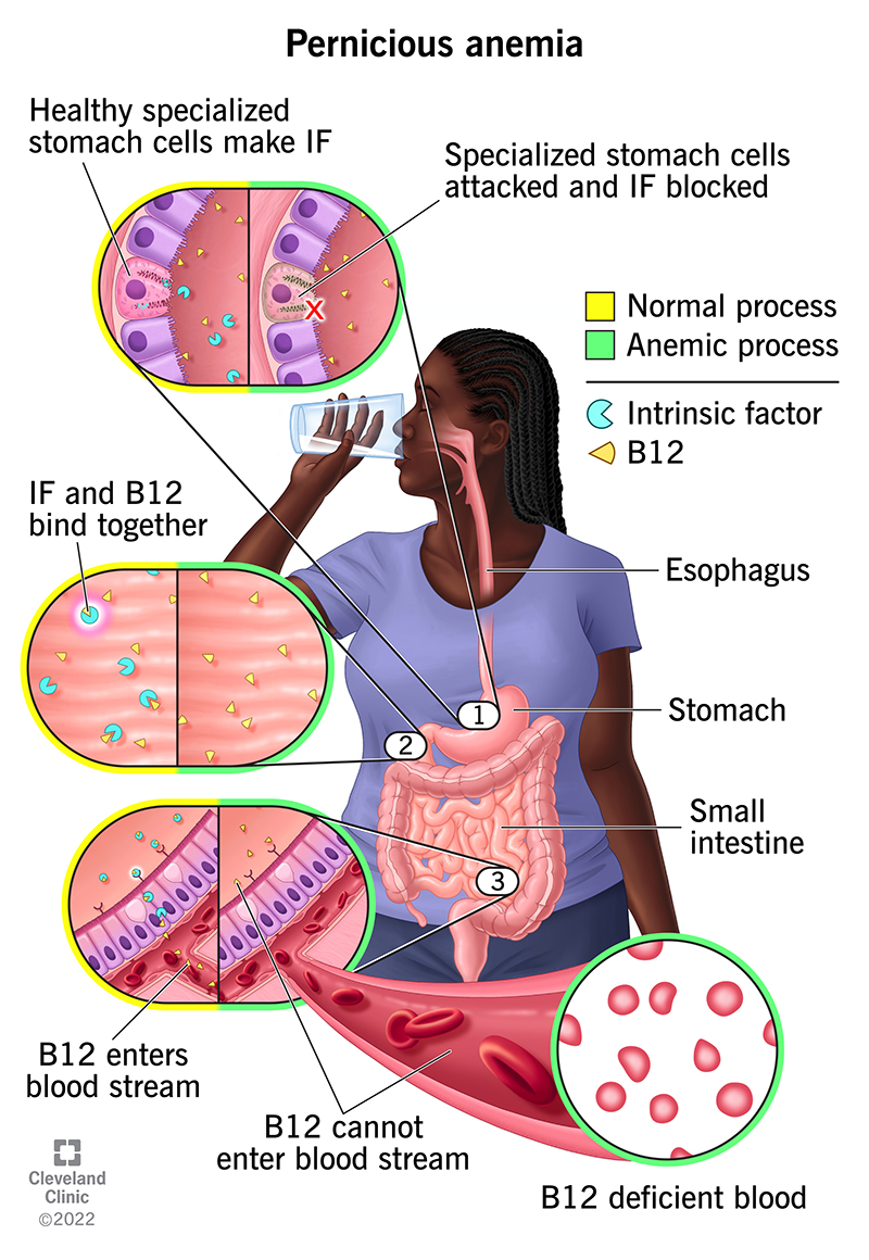 (Center) woman drinking liquid. (Center)  inset of esophagus, stomach and small intestine. (Bottom) Blood stream with detail on B-12 deficient blood. (Left from bottom to top) Ovals with detail on normal processes (left side of ovals) and abnormal processes (right side of ovals).