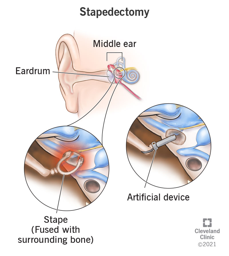 Middle ear (top) with close up showing details of existing fused stape (lower left) with artificial device (lower right).