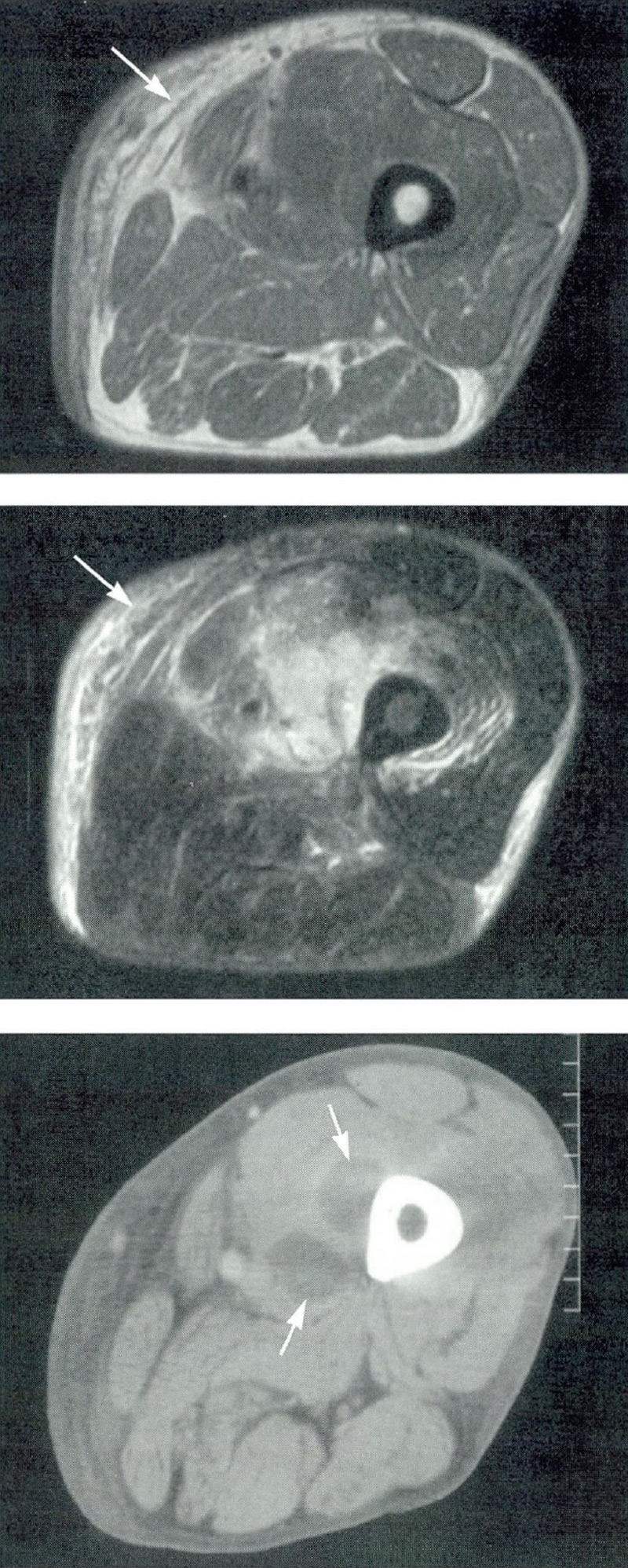 MRI images (top two images) show inflammation in thigh tissue. The CT scan (bottom image) shows an abscess (pyomyositis) that formed near the thigh bone (femur).