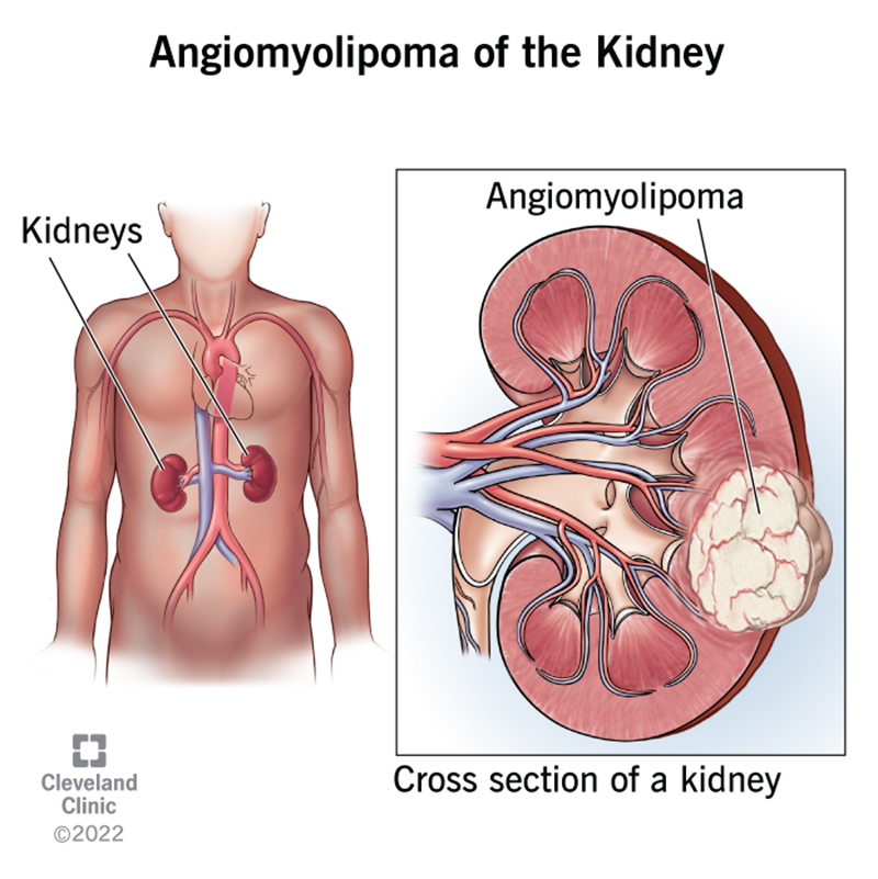 An angiomyolipoma of the kidney is made of fat, smooth muscle and blood vessels.