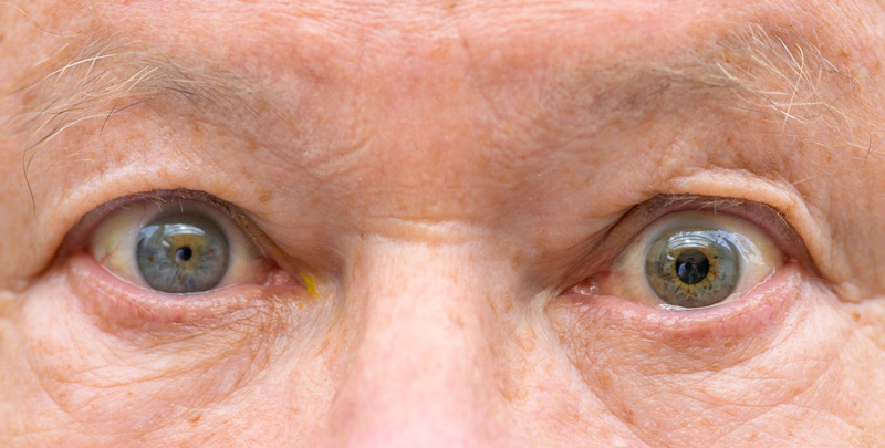 Anisocoria (Unequal Pupil Size): Symptoms & Causes